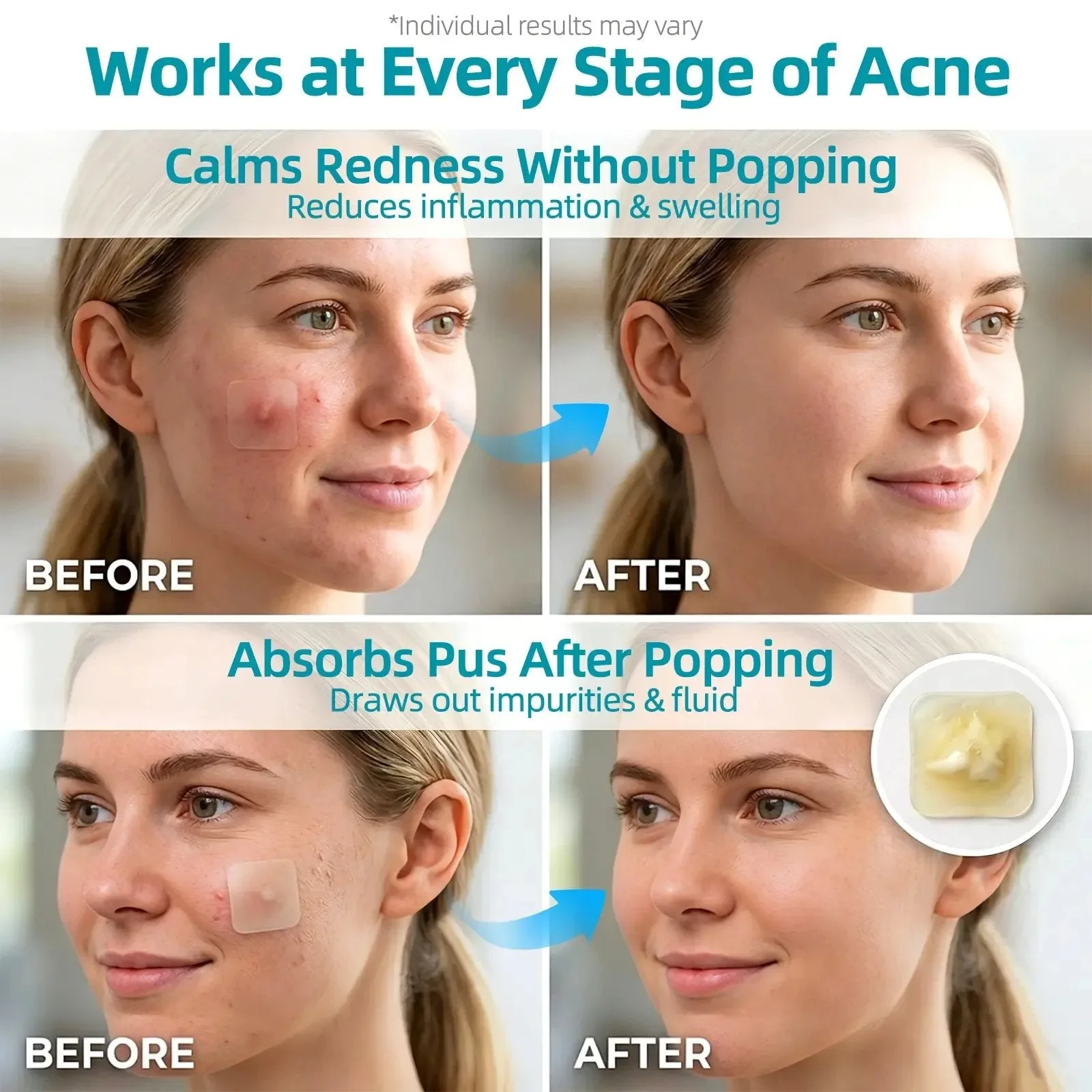 🏆75K+ SOLD!✨ Medical-Grade Hydrocolloid Acne Patch Roll